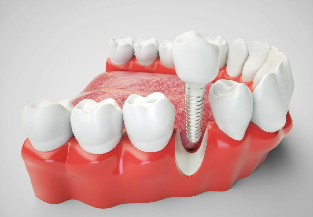 coste implantes dentales