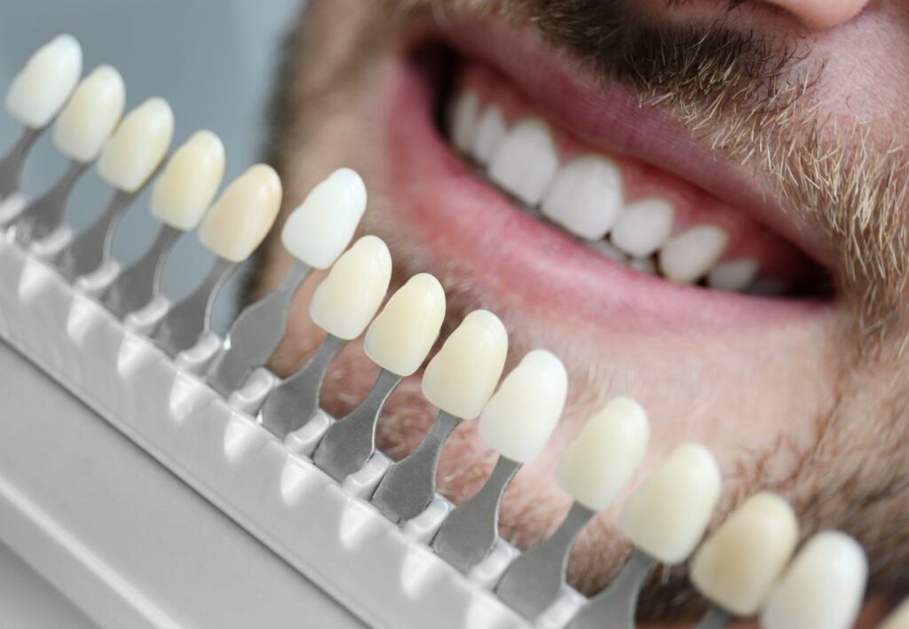 ventajas carillas dentales