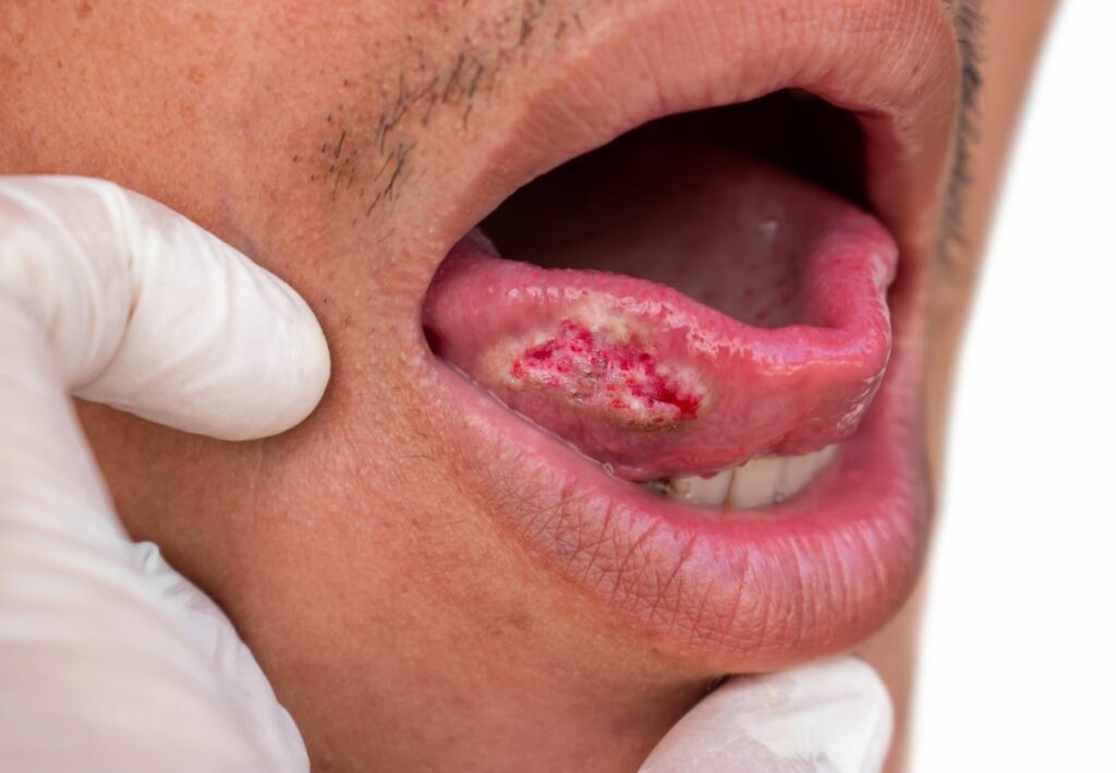cancer de boca sintomas