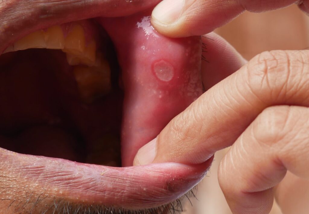 cáncer oral síntomas