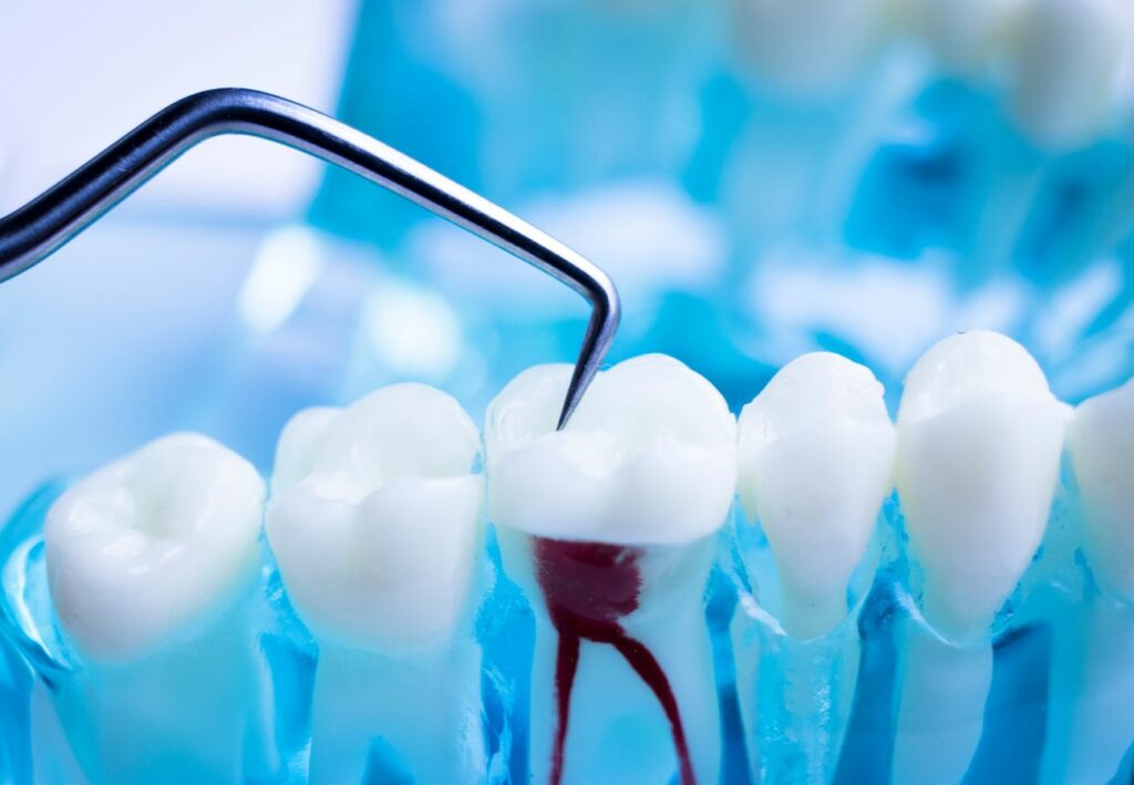 dentista endodoncia gijón