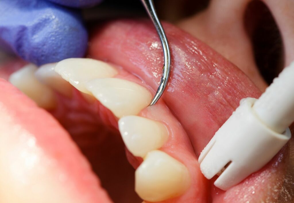 gingivitis vs periodontitis