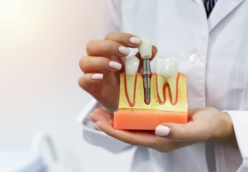 implantes dentales