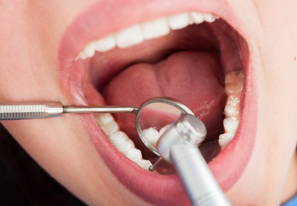 muela con endodoncia