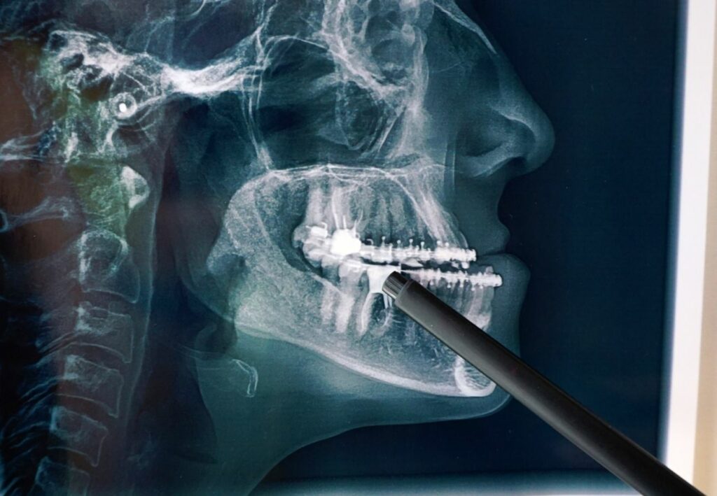 postoperatorio operación maxilofacial