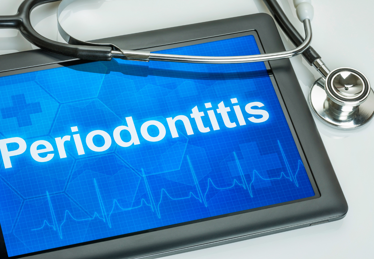 qué es periodontitis