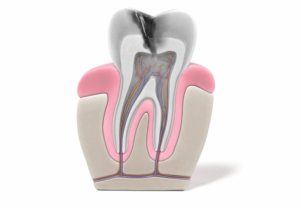 qué es una endodoncia