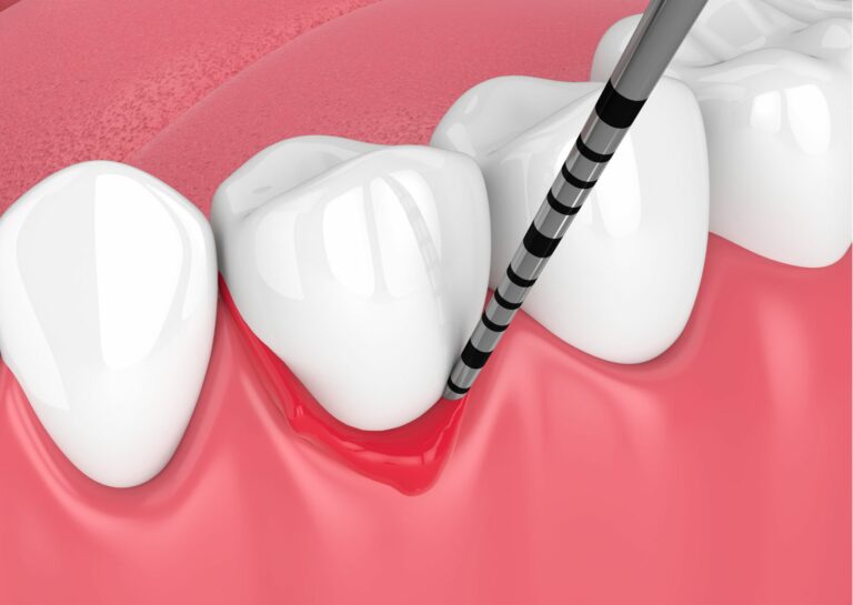 Bolsa periodontal: Riesgos y tratamientos eficaces - ZIGOMAT