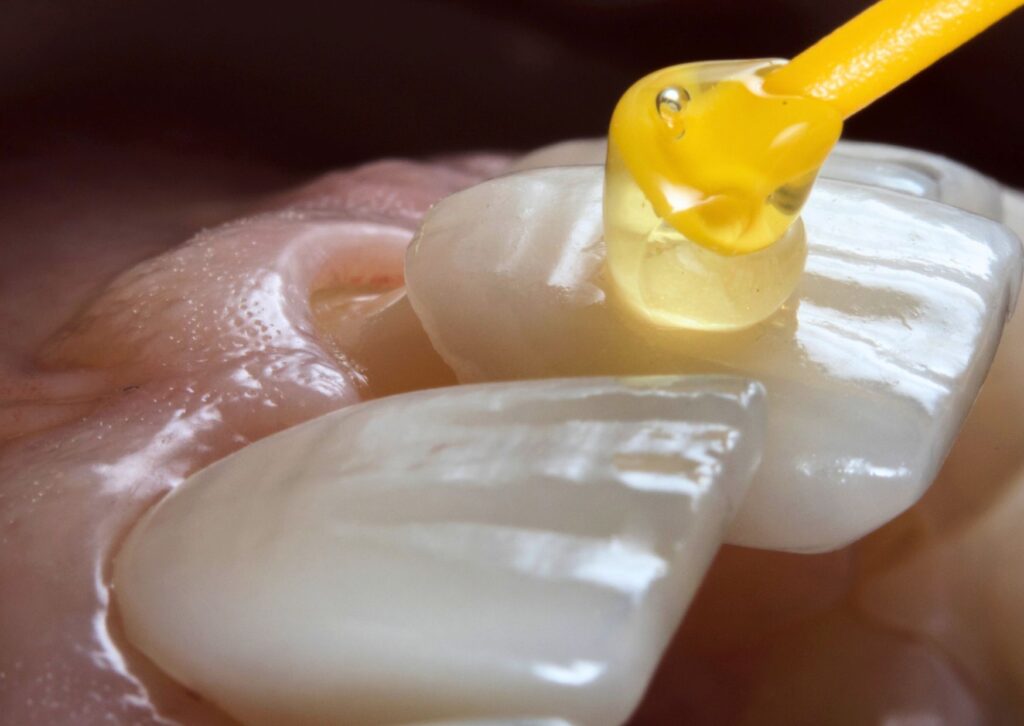 carillas dentales precio