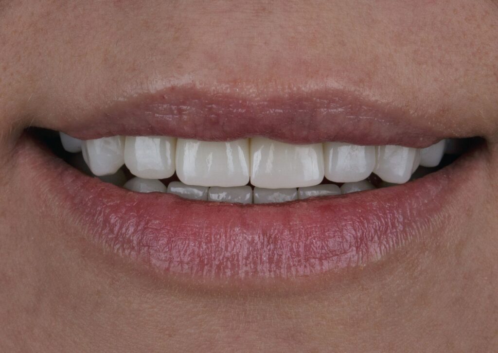 precio carillas gijón