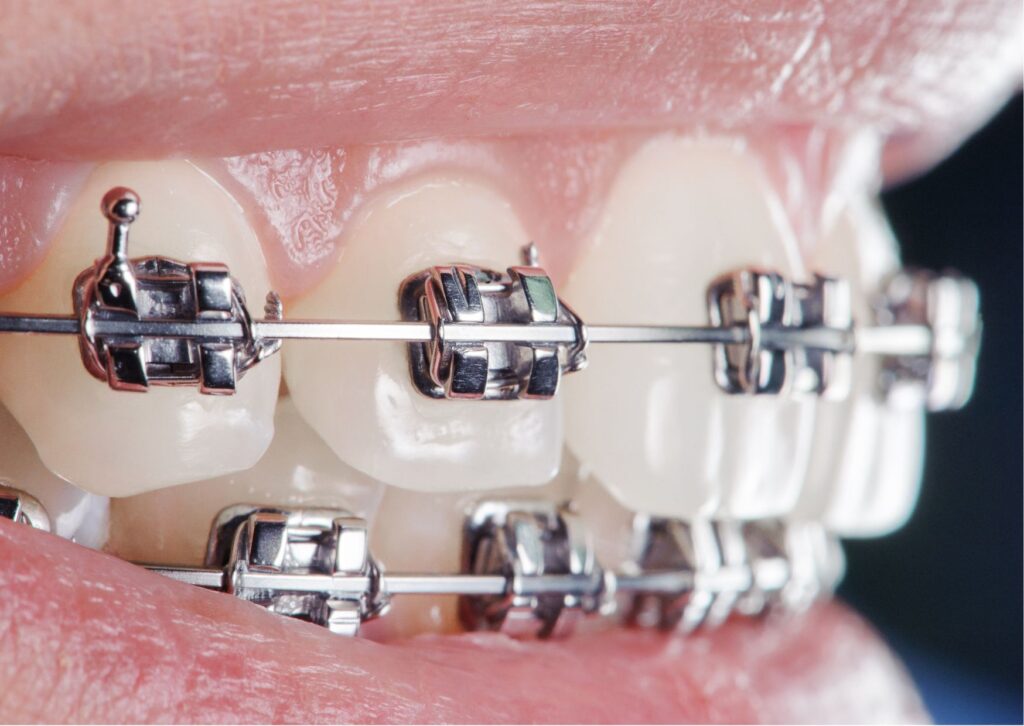 corrección de mordida cruazada