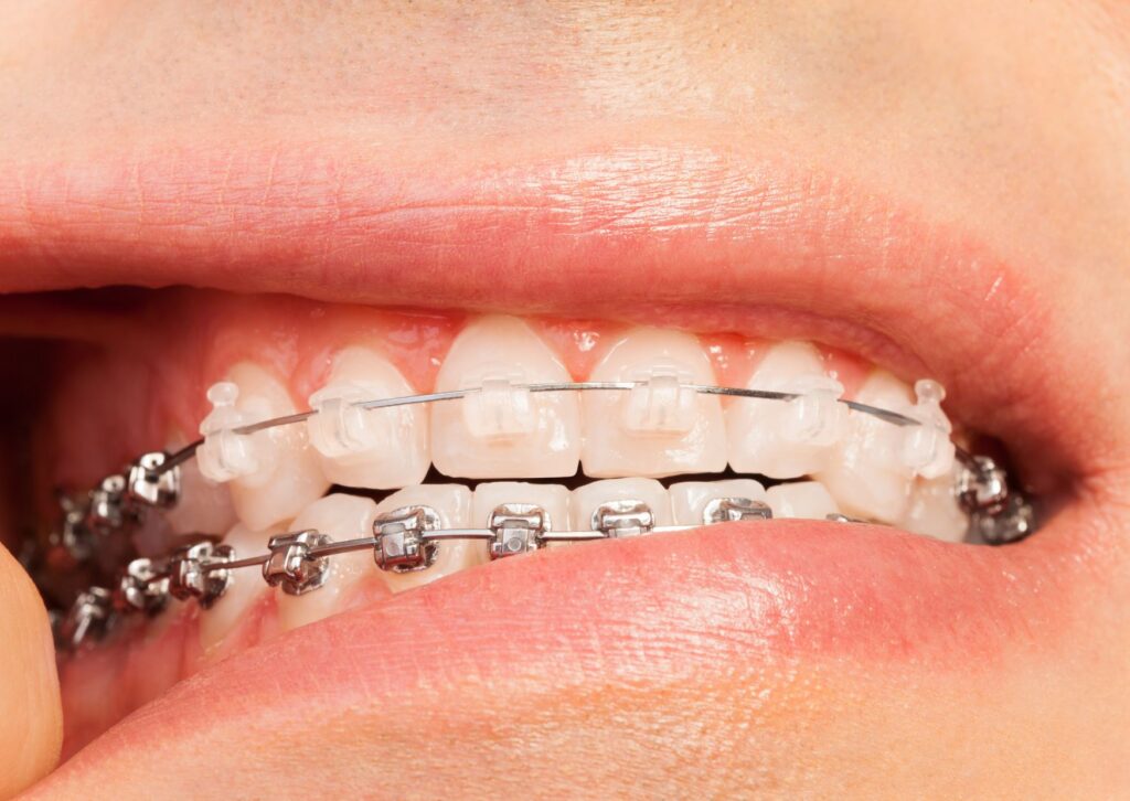 tratamiento para mordida abierta