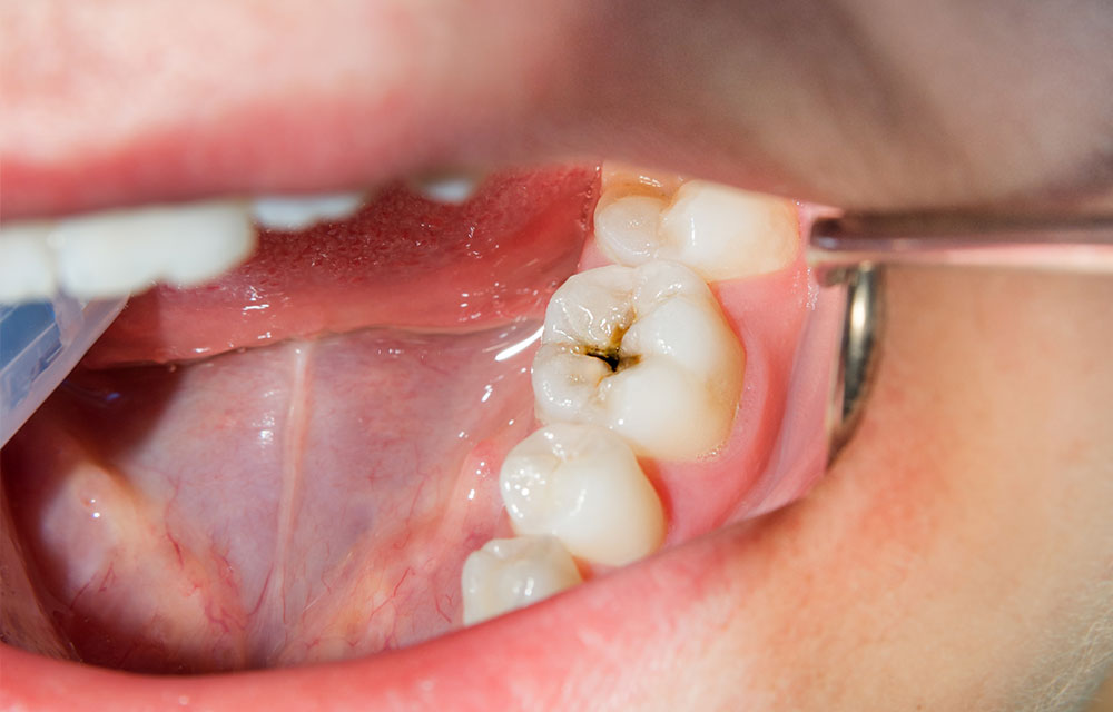 prevenir caries zaragoza Clínica dental en Gijón