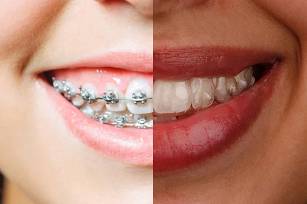 Diferencia entre ortodoncia invisible y brackets tradicionales