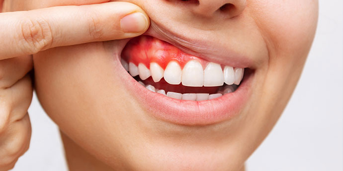 como solucionar el sangrado de las encias