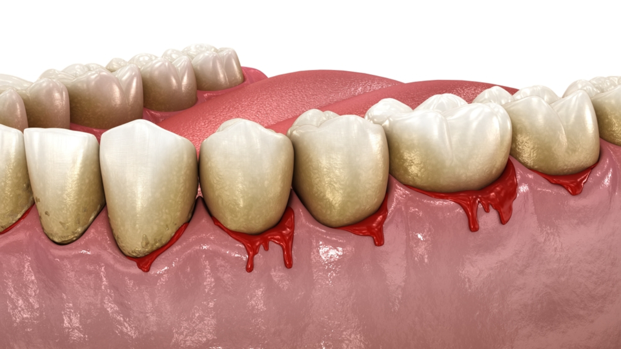 por que sangran las encias