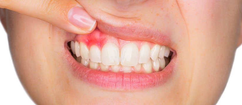 sangrado en las encias