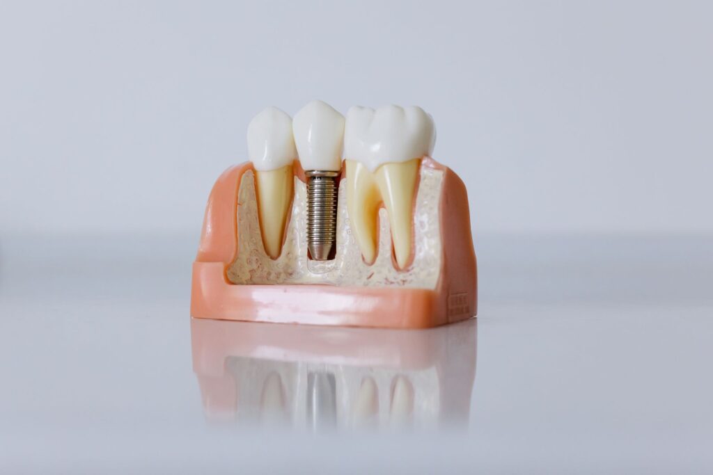 Duele ponerse un implante dental